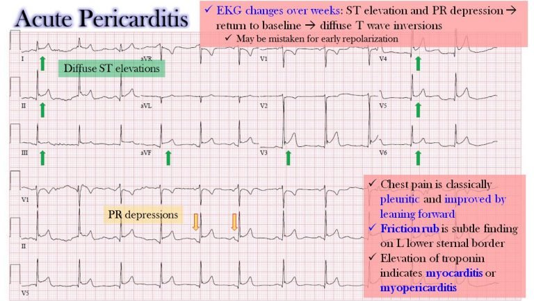 ECG changes in Acute Pericarditis